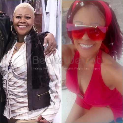 Sleeve to RNY Bypass Revision Surgery